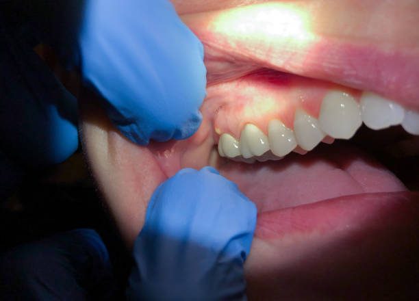 Best Knocked-Out Tooth Emergency  in Contoocook, NH